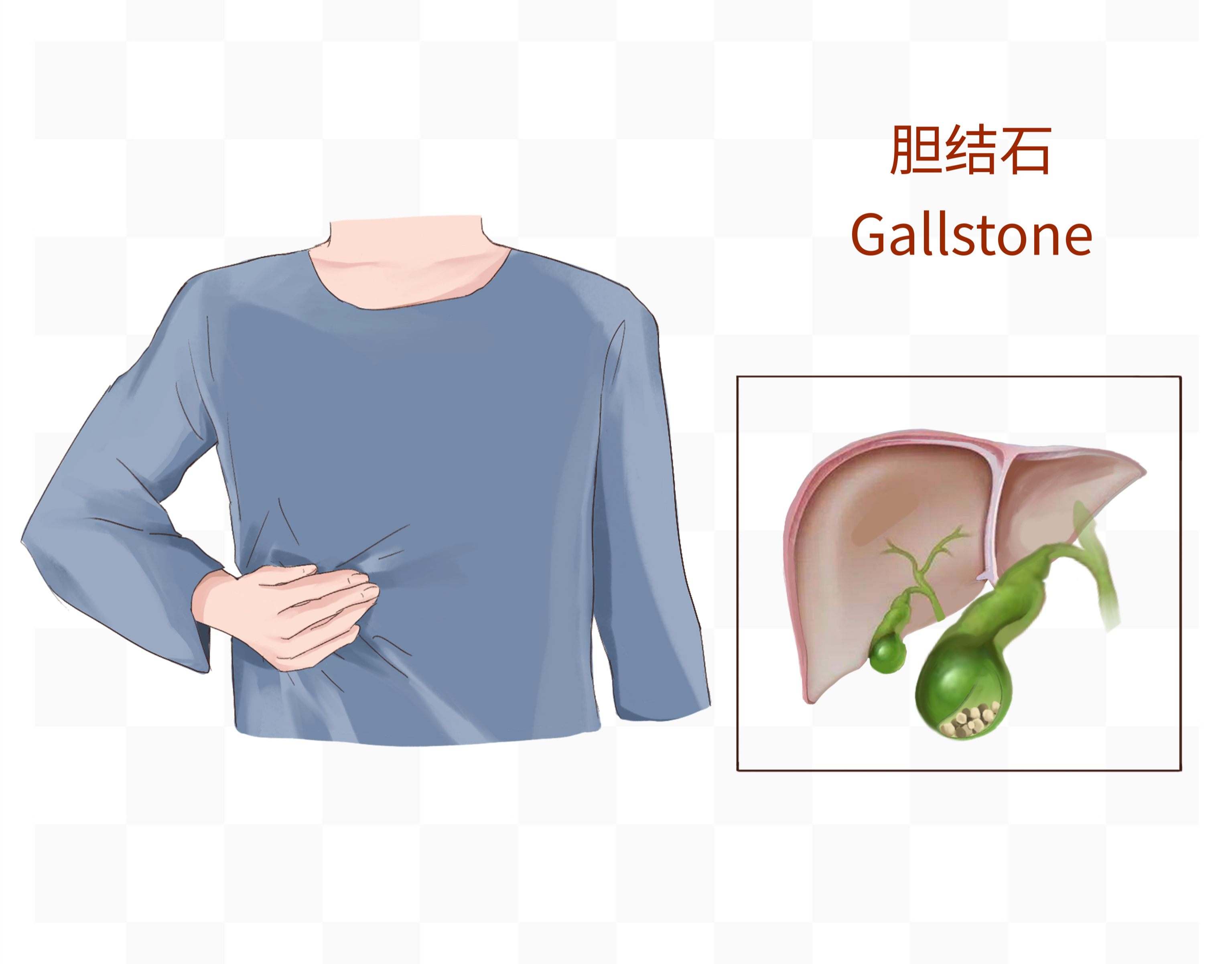 “65岁，我下定决心切除胆囊…”