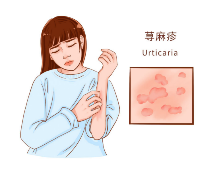 医生自述：我是如何治愈自身荨麻疹的