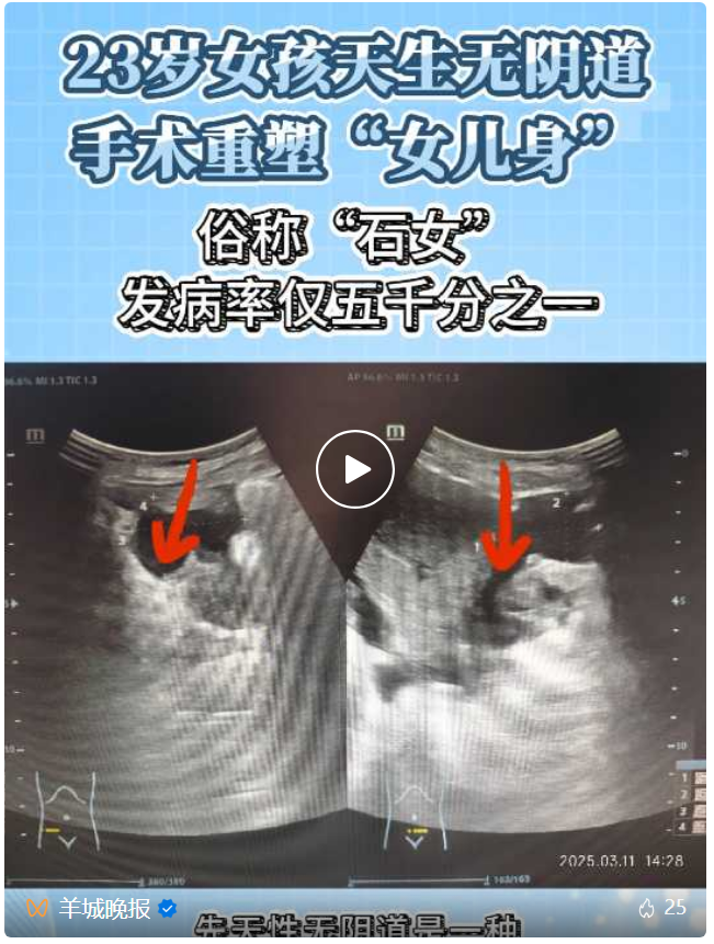 羊城晚报（视频号）23岁女孩天生无阴道，辗转求医10年，3月7日广州医疗团队成功为其实施手术重塑“女儿身”。