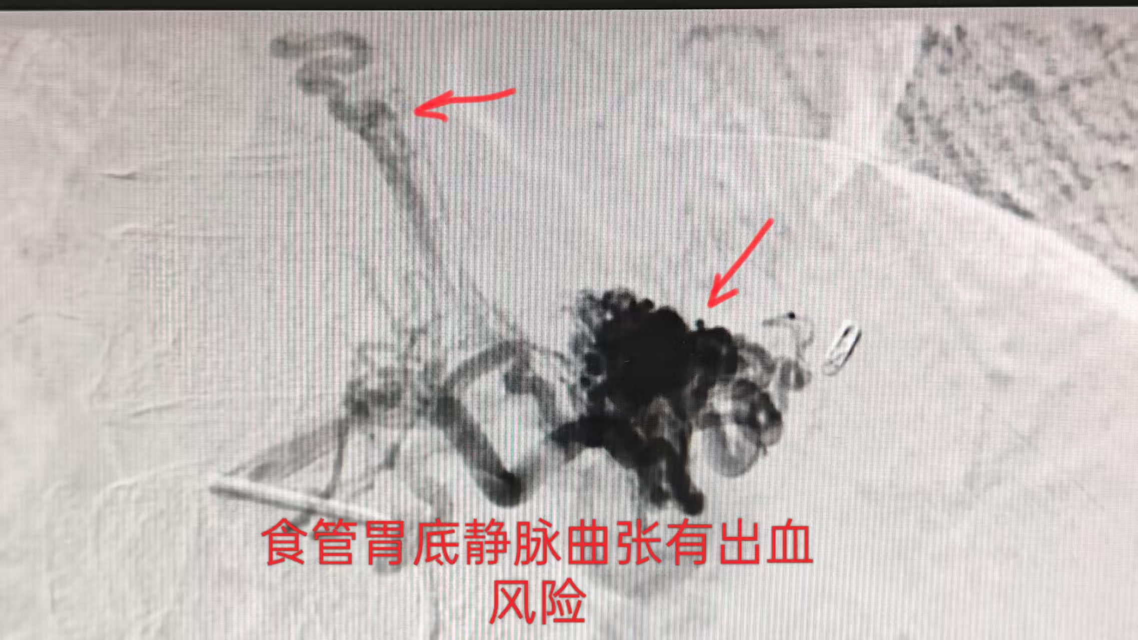 厉害了！一针“栓”除危机