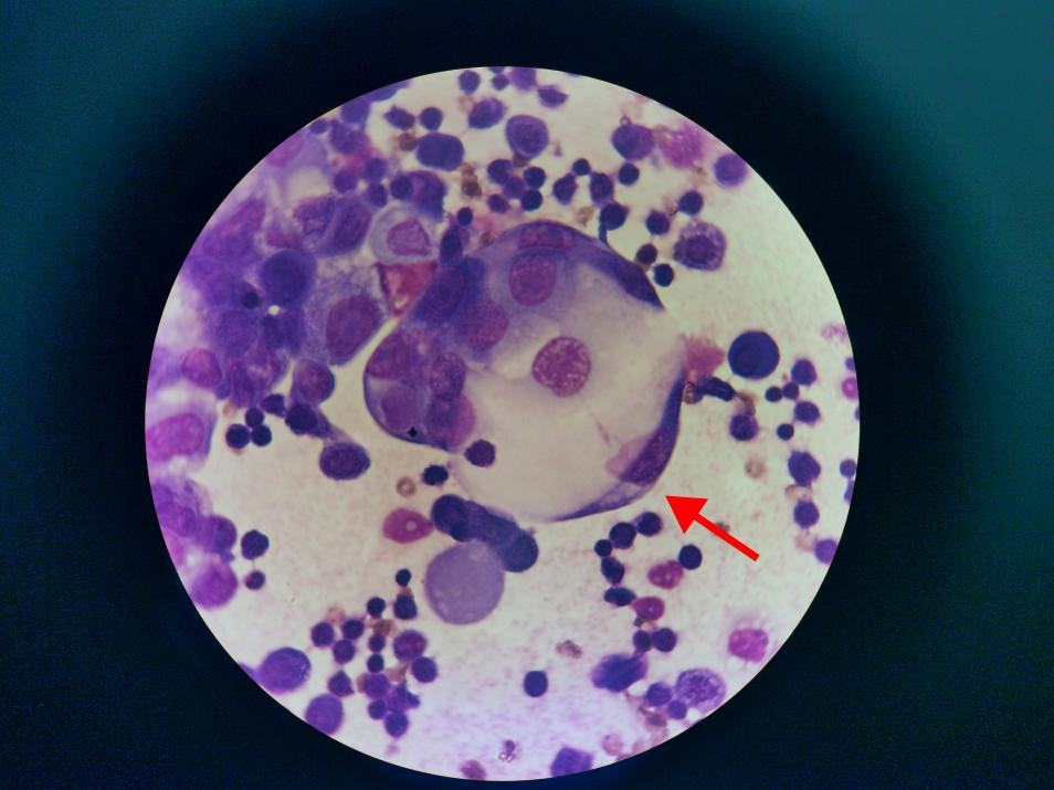 腹痛疑云半月,常规检验揪出“不速之客”→