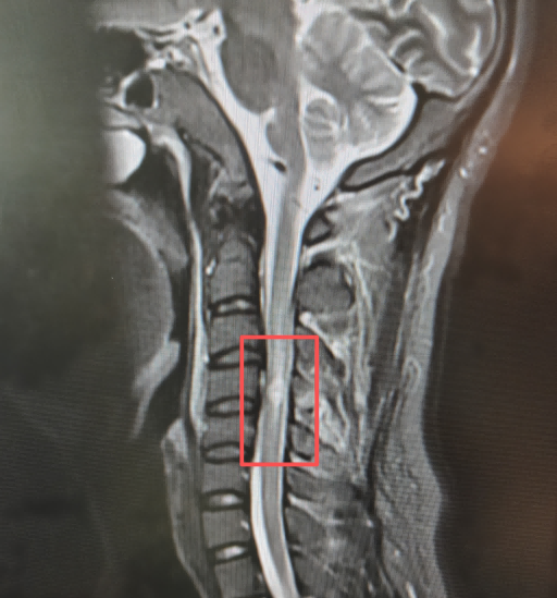 小伙被追尾后双腿发软,起因竟是这个日常习惯