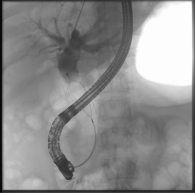 【39健康网】胆管“卡”石头？ 消化内科专家25分钟完成ERCP取石术