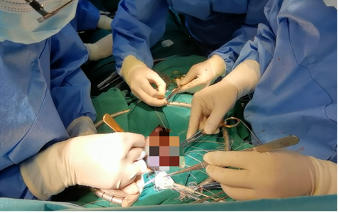 【39健康网】悬崖走钢丝，气球上绣花！ 广东祈福医院成功开展两项心脏手术创番禺纪录！