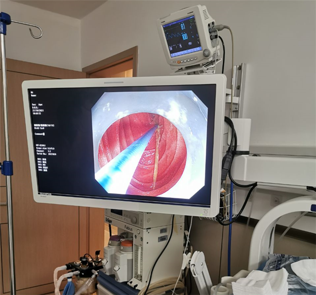 【潇湘晨报】震惊！女子突发腹痛难忍，竟是醉酒后误吞了这个，你家也有