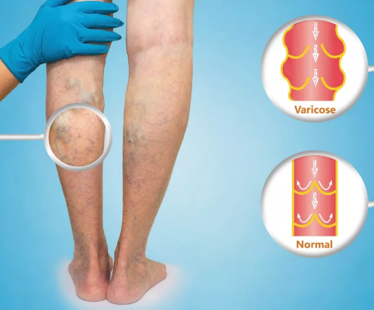 夏天露腿季，一不小心被“小蚯蚓”减分