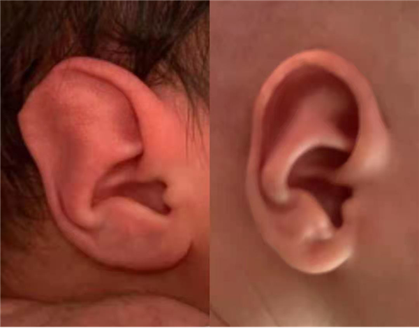 宝宝耳朵不好看？耳廓矫正应尽早，避免影响孩子心理健康