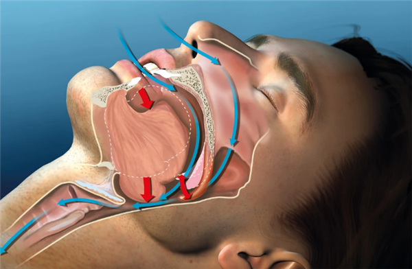 打鼾有多可怕? 是时候做个睡眠监测检查了