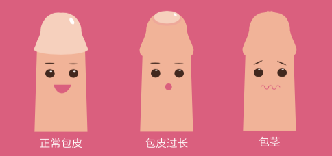 【敲黑板】医生，我儿子的包皮要不要割？