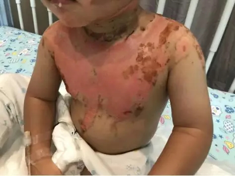 警惕！2岁内孩子烫伤频发，该如何保护你我的孩子！