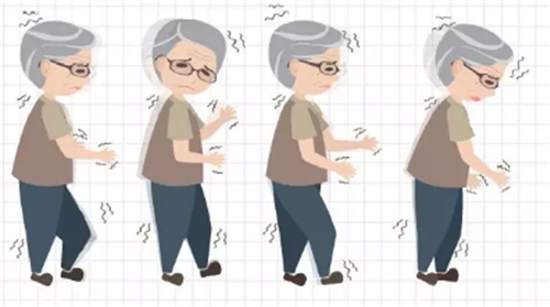 走路慌张，说话含糊，手抖，“心虚”？NO，帕金森病找上门！