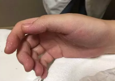 产后手汗就像露水一样冒，密密麻麻……孩子都不敢抱