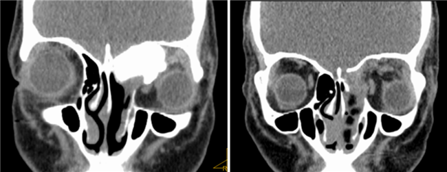 【南方网】花季少女患病长出“金鱼眼”，一查竟是……