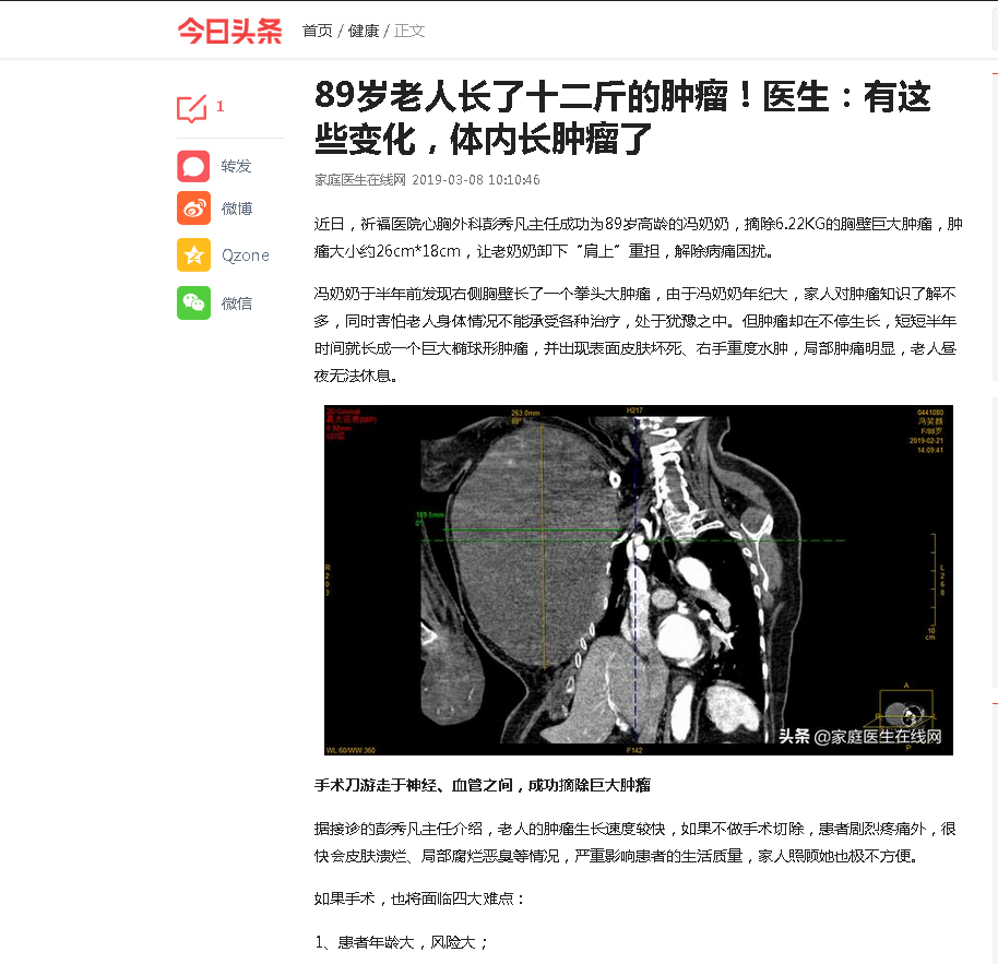 【今日头条家庭医生在线网】89岁老人长了十二斤的肿瘤！医生：有这些变化，体内长肿瘤了