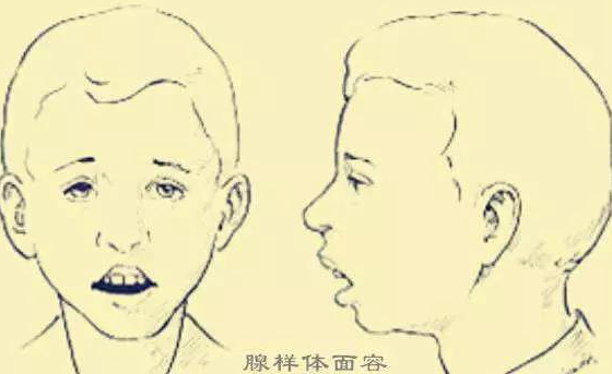 宝宝长期睡觉打呼噜、张口呼吸是病不是萌！家长们要警惕！