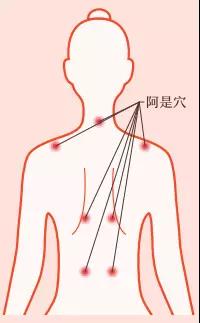 防未病治已病，穴位敷贴给您“贴”身关照！