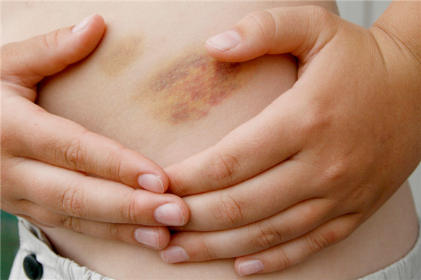 孩子皮肤反复出现瘀点、瘀斑，当心免疫性血小板减少性紫癜