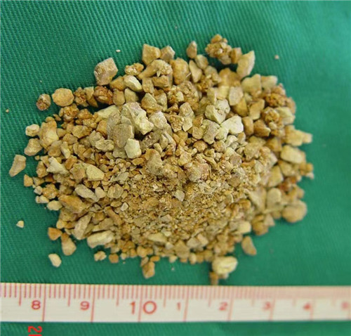 【家庭医生在线】“石”尽甘来，广东祈福医院上演“碎石记”